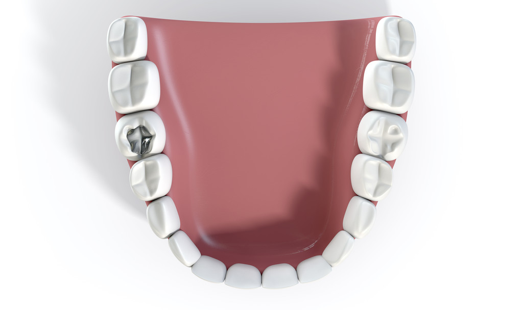 Cavity Filling Timeline and Recovery: Guide to the Procedure
