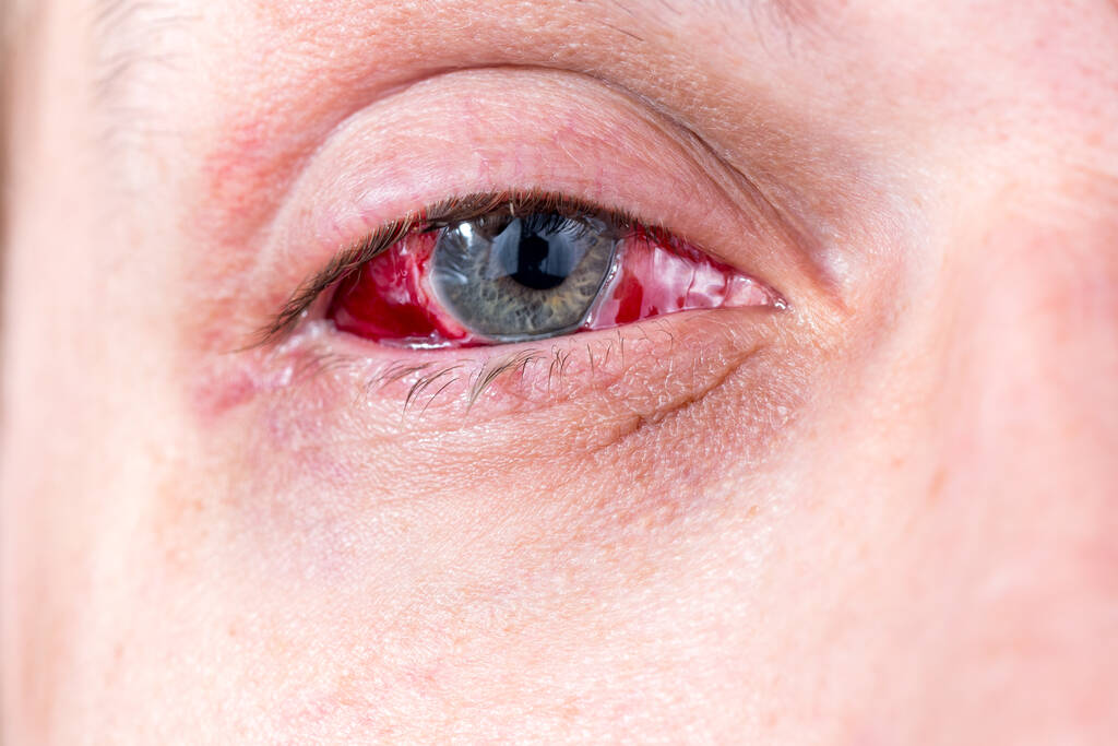 How Long Can Pink Eye Live on Fabric?