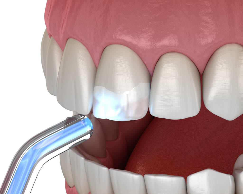 What if the Cavity Is Below the Gum Line?