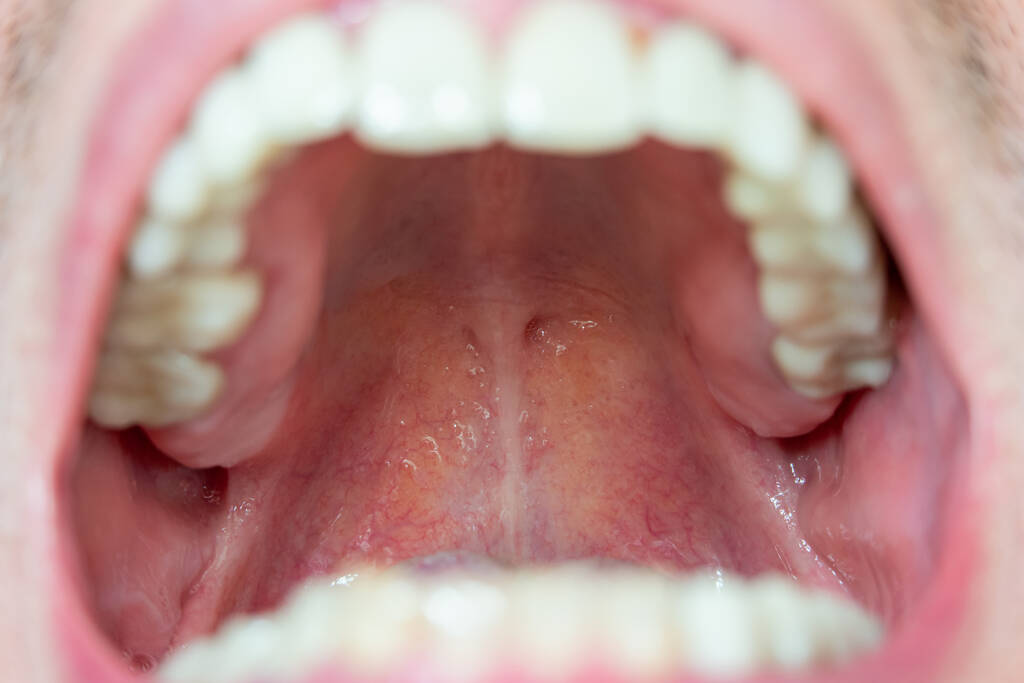 Why Is the Roof of My Mouth Yellow and How to Fix It